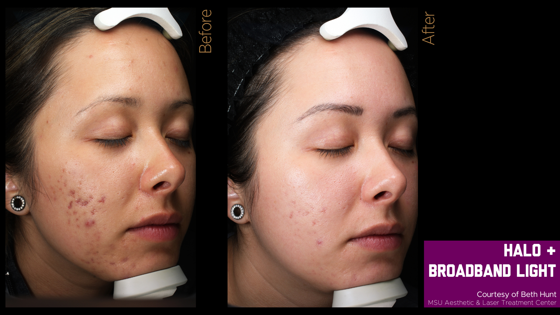 before and after halo treatment