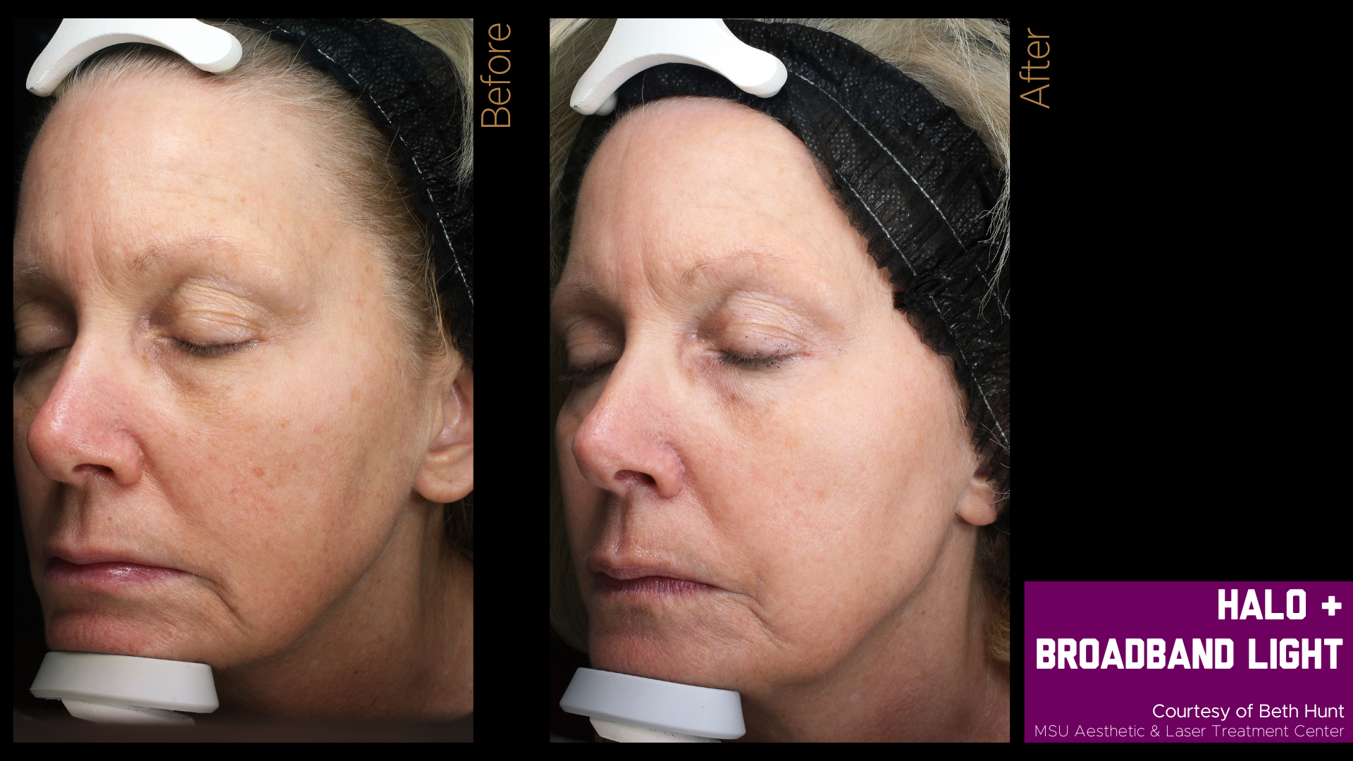 before and after of a halo treatment