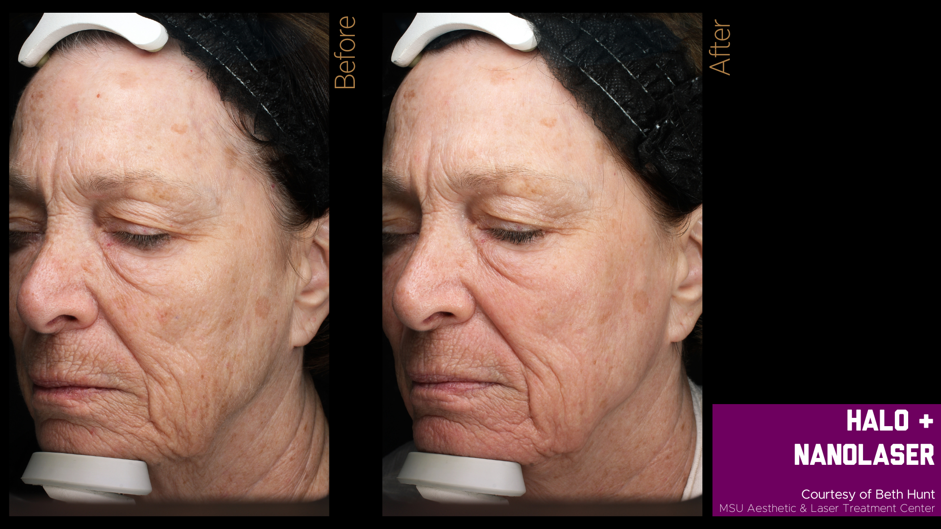 before and after of a halo treatment