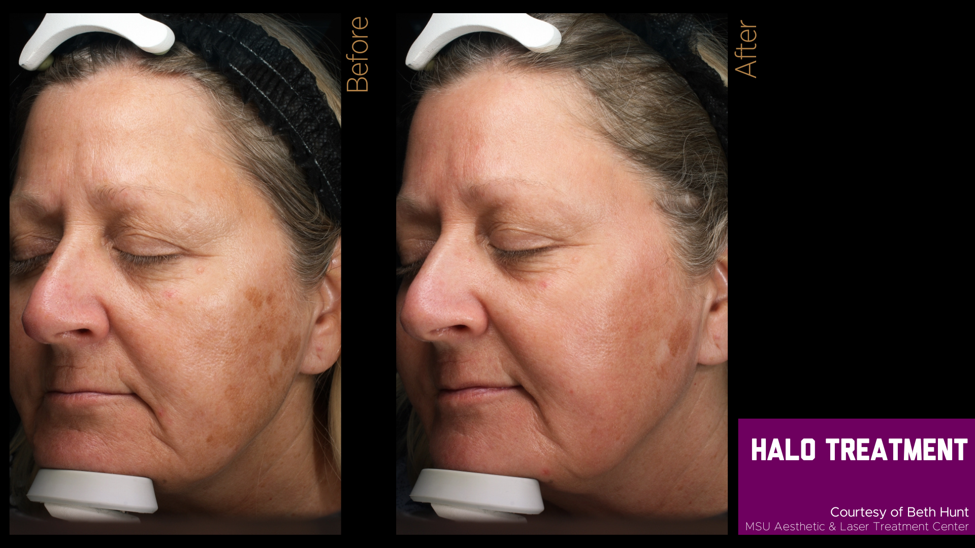 before and after of a halo treatment