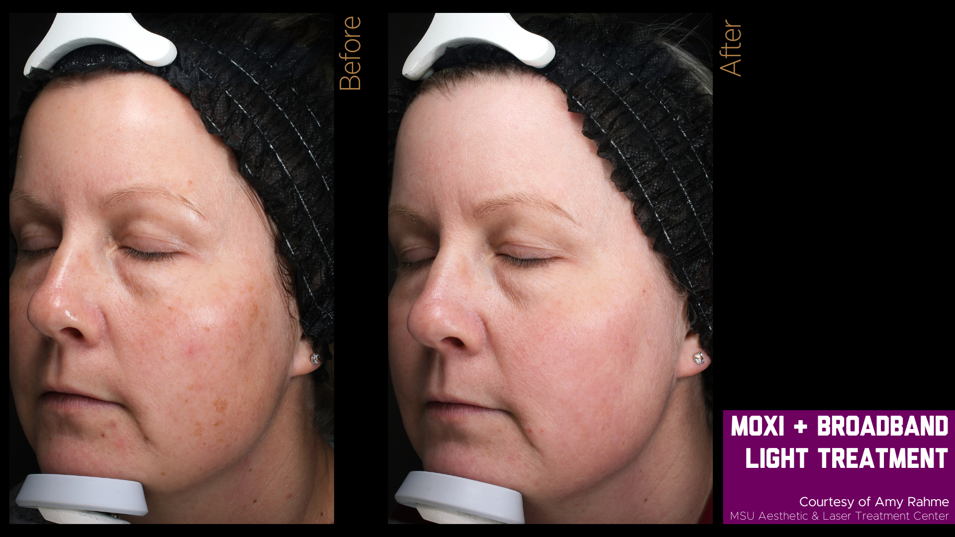 before and after of a moxi treatment