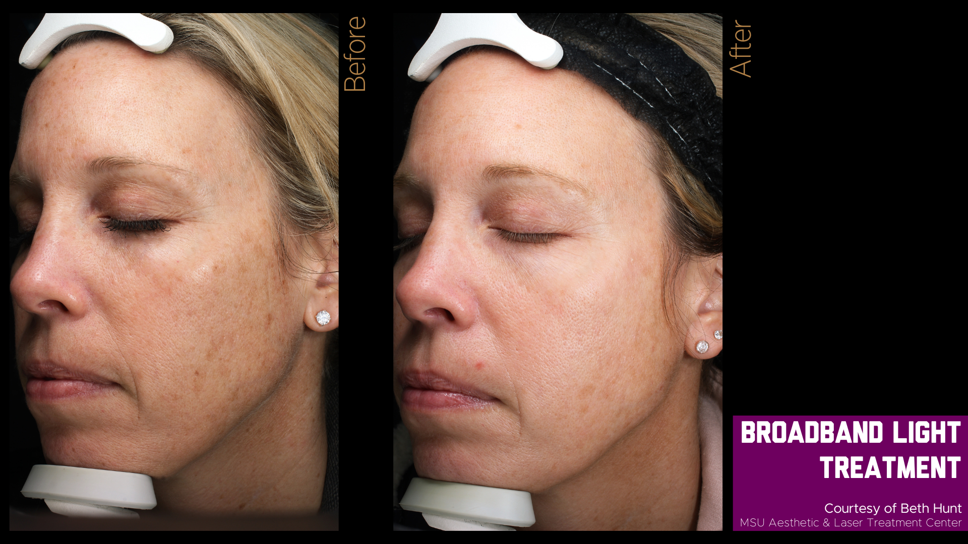 before and after photos of a broadband light treatment