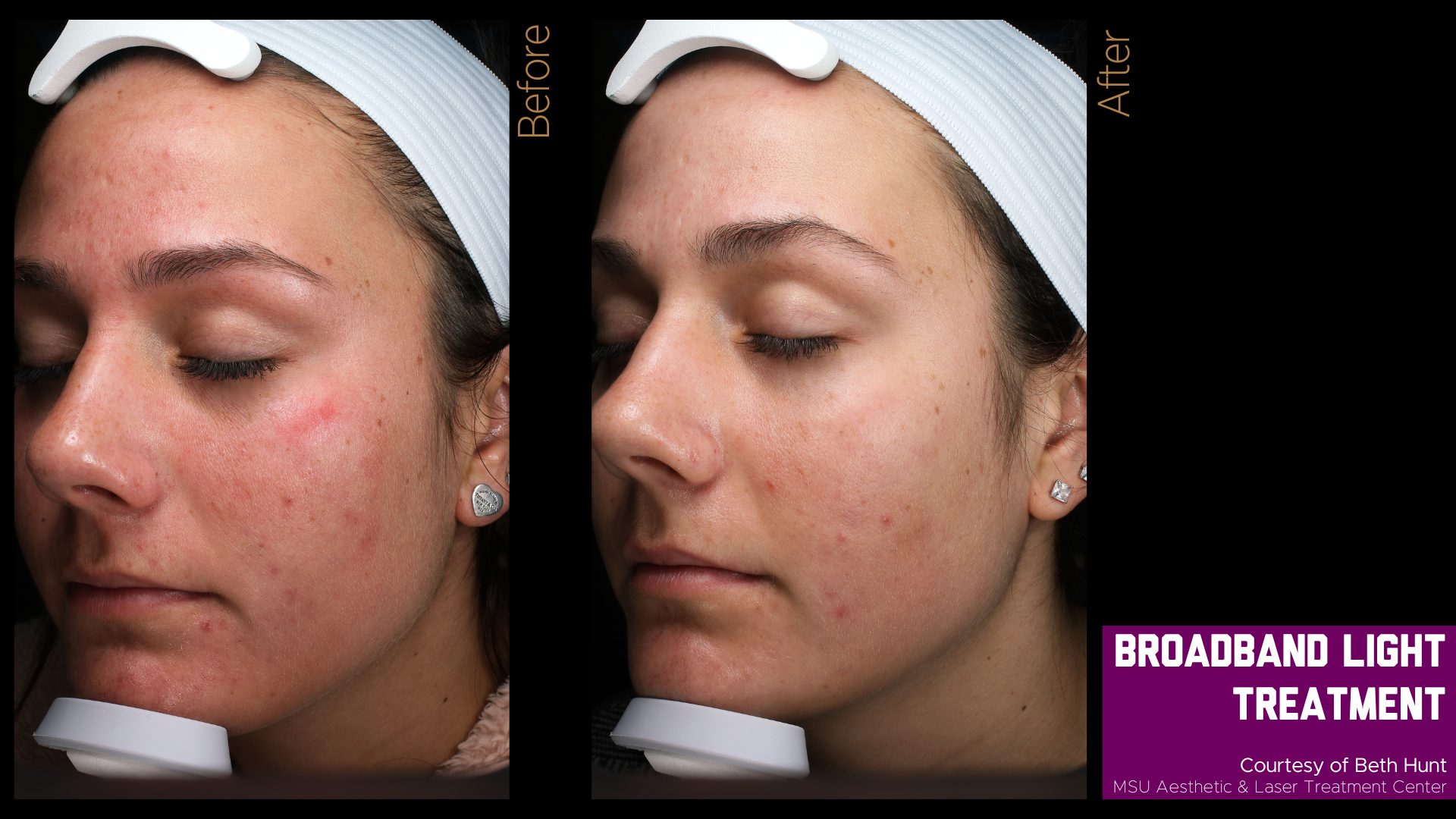 before and after photos of a broadband light treatment