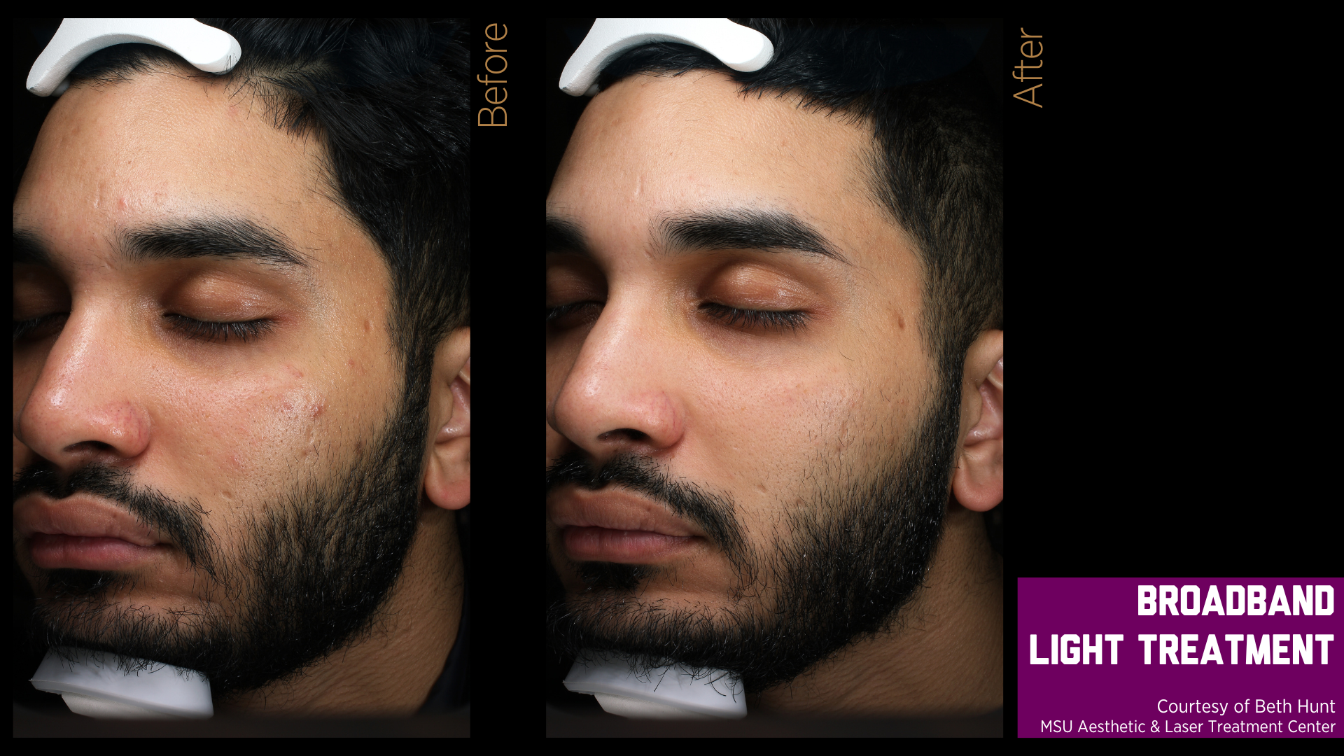 before and after treatment photos