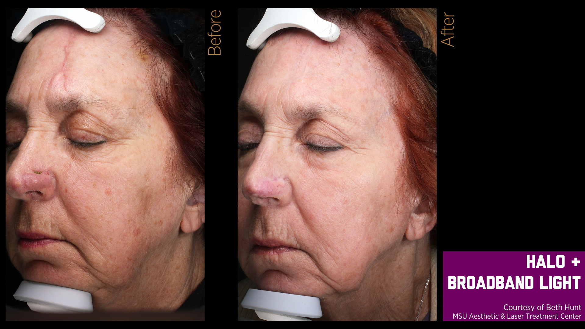 before and after treatment photos