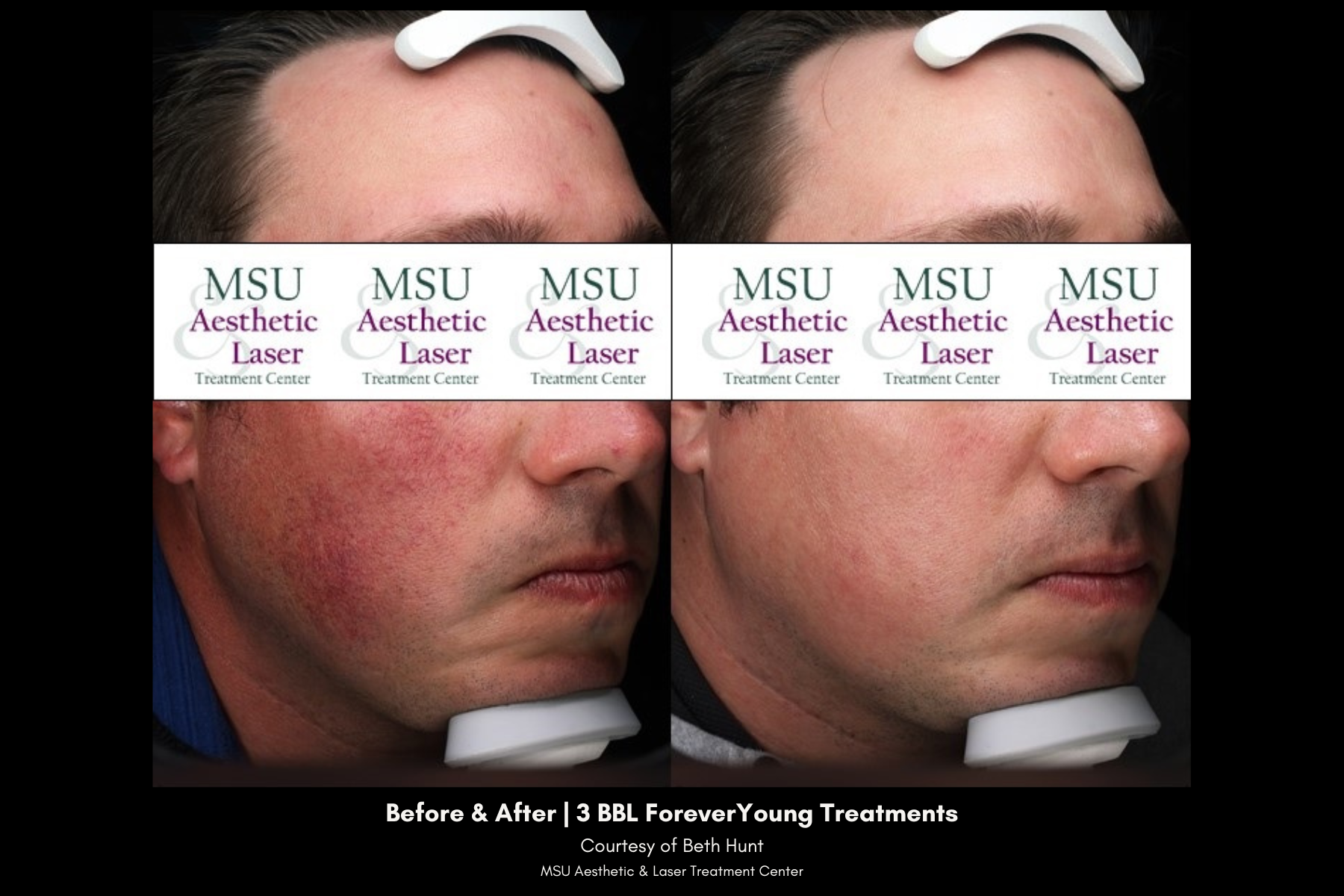 before and after photos of redness treatment